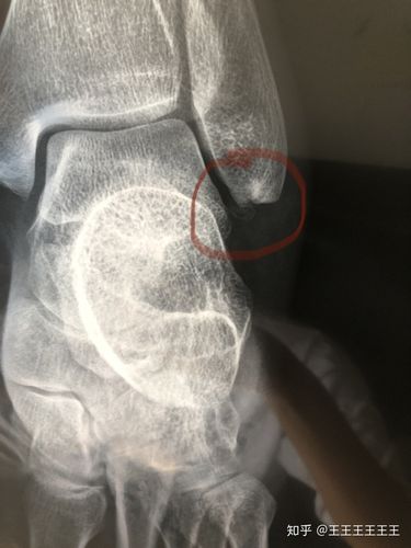 刘礼嘉踝关节撕脱性骨折的相关图片